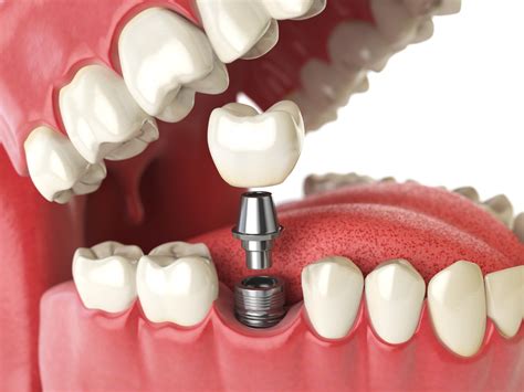 Cấy ghép implant Nha khoa Stone