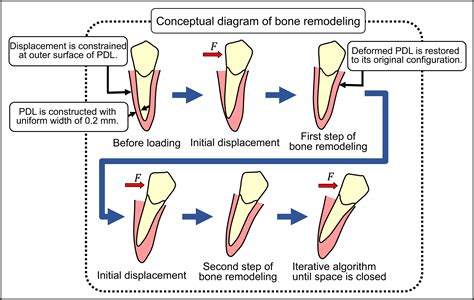 Numeric Simulation Model For Long Term Orthodontic Tooth Movement With Contact Boundary