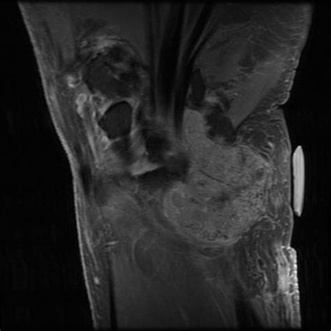 Case Of Tumoral Calcinosis On Images A Rare Clinicopathological Entity