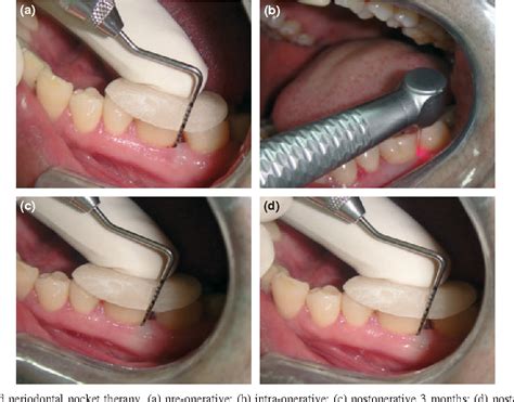 Figure From Comparison Of Periodontal Open Flap Debridement Versus