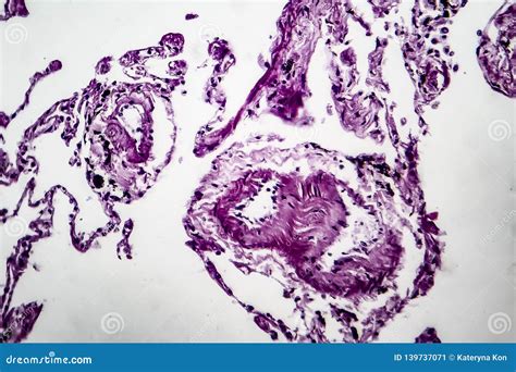 Lung Emphysema Light Micrograph Stock Image Image Of Alveoli