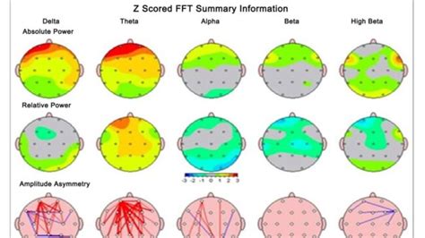 Neurofeedback For Migraines And NFB Protocol