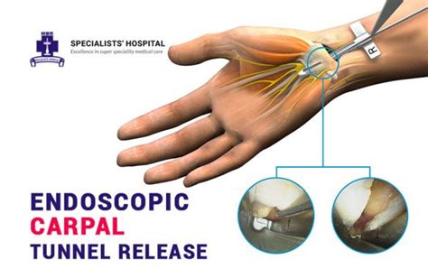 Endoscopic Carpal Tunnel Release | Minimally Invasive Relief