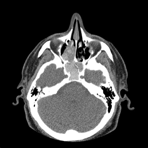 Recurrent Acute Rhinosinusitis Statpearls Ncbi Bookshelf