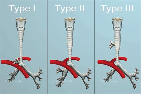 Classification Of Congenital Tracheal Stenosis With Circular O Rings