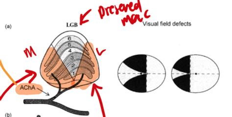 Homonymous Hemianopia Flashcards Quizlet