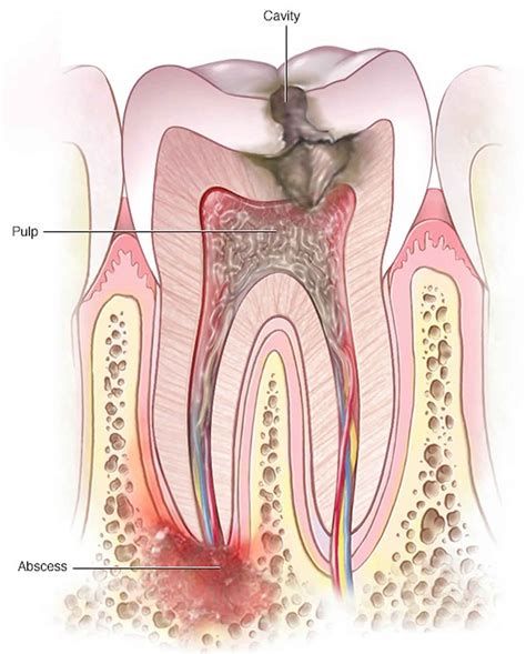 Periapical Abscess Causes Symptoms Diagnosis Treatment Prognosis