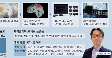 Ai가 전송영상 분석15분내 뇌경색 징후 판독