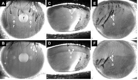 Figure 4 From Mechanisms Imaging And Structure Of Tear Film Breakup