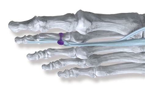 Syndesmosissoft Tissue Fixation System Nxtmed