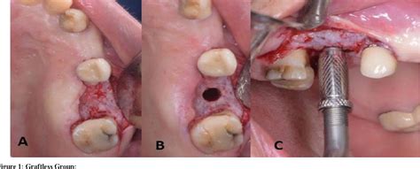 Figure From Xenograft Versus Graftless Crestal Sinus Lift With