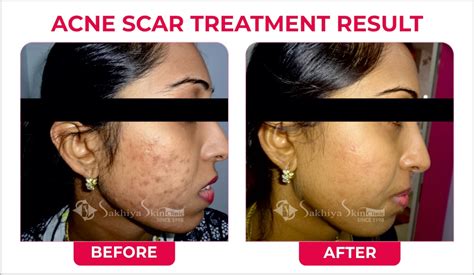 Acne Scars Removal Laser Treatment Sakhiya Skin Clinic