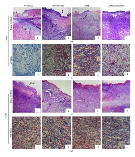 Microscopic View Of Healing Wound Tissue And Epidermal Dermal