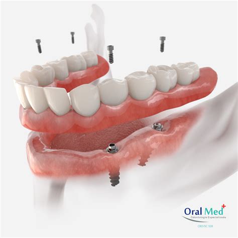 Como é Colocada A Prótese Tipo Protocolo Oralmed Odontologia