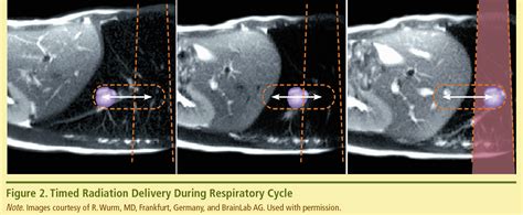 Figure 2 from Overview of stereotactic body radiotherapy and the ...