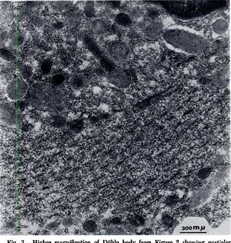 Figure 1 from The May-Hegglin anomaly: platelet function, ultrastructure and chromosome studies ...