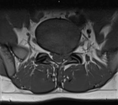 Disc Protrusion L5-S-1 : r/Sciatica