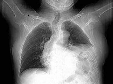 Diaphragmatic Eventration Presenting With Sudden Dyspnoea Bmj Case