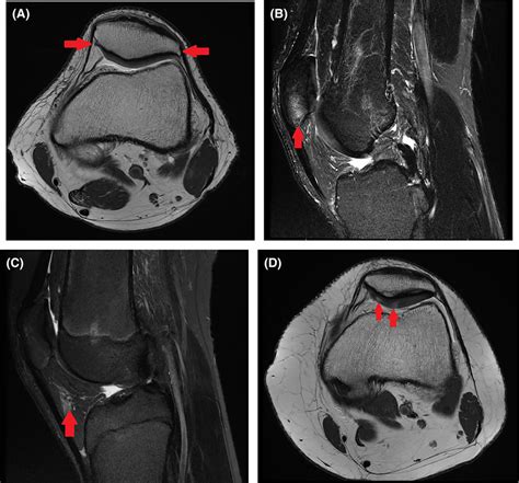 Structural Abnormalities A Osteophytes On Patella Axial Proton Download Scientific Diagram