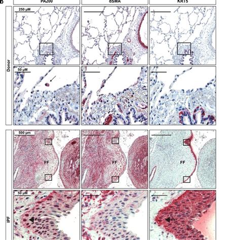 Pa Is Upregulated In Ipf Lungs A Homogenates Of Human Ipf And