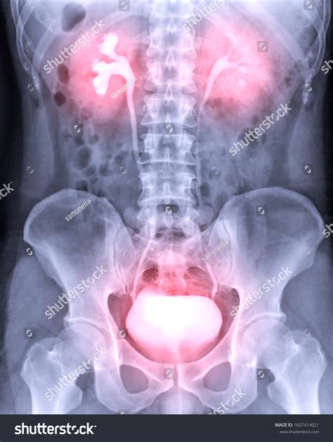 Intravenous Pyelogram Ivp Xray Exam Urinary Stock Photo Edit Now