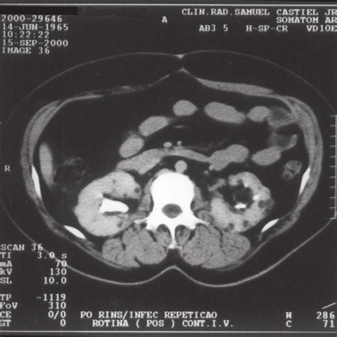 Pdf Bilateral Giant Renal Angiomyolipoma Associated With Hepatic