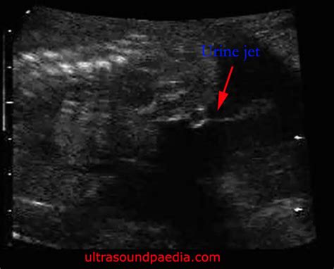 Hypospadias Ultrasoundpaedia