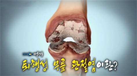 명의 의학백과📖 퇴행성 무릎 관절염이란 Youtube