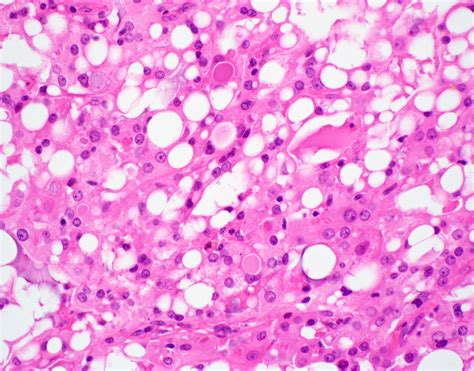 Pathology Outlines Secretory Carcinoma