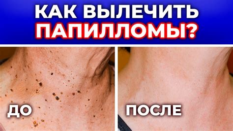 Откуда берутся БОРОДАВКИ — ЭТО ЗАРАЗНО? / Как удалить папилломы в ...