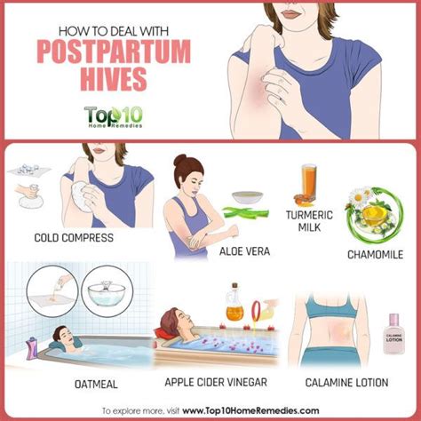 How To Deal With Postpartum Hives Top 10 Home Remedies