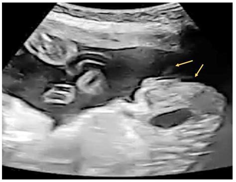 Ultrasonographic Diagnosis of Fetal Hypospadias