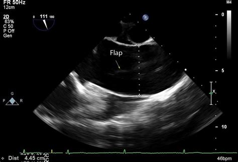 The Image Illustrates The Dilated Ascending Aorta And The Dissection Download Scientific