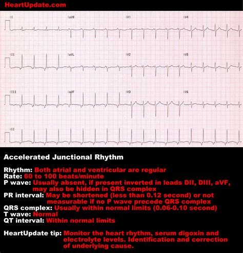 Accelerated Junctional Rhythm - HeartUpdate.com | Ekg interpretation ...