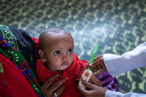 مكافحة مرض سوء التغذية بين الأطفال Unicef منطقة الخليج