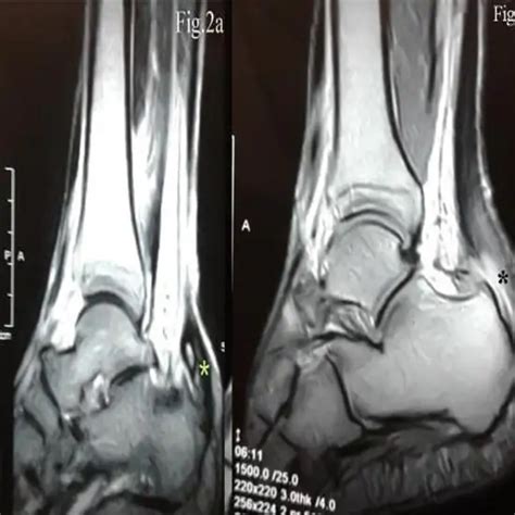 Mri Right Ankle Joint Test Price In Delhi Ganesh Diagnostic