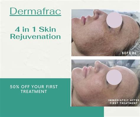 Dermafrac Skin Needling — Exquisite Laser Clinic