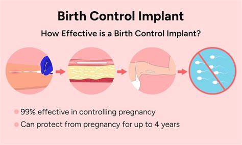 Premium Vector | Birth control implant information in vector