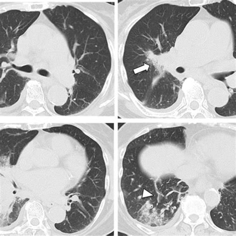 Macroscopic Findings Of The Lung Macroscopically Pulmonary Hemorrhage