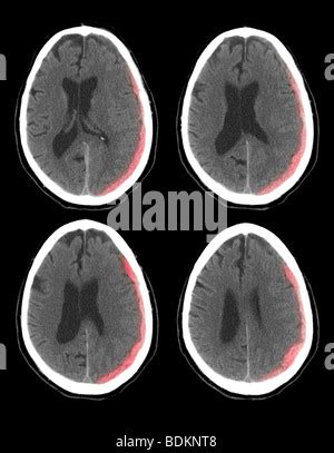 CT scan de cerveau show ancien droit basal ganglia avec hémorragie