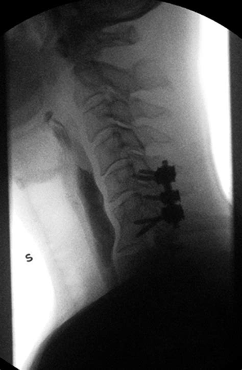 Esophageal Perforation After Anterior Cervical Spine Surgery Jtcvs