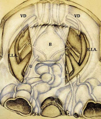 -At the end of the peritoneum suture the peritoneal cavity and... | Download Scientific Diagram