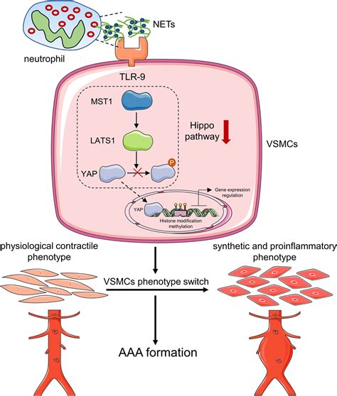 Neutrophil Extracellular Traps Induce Abdominal Aortic Aneurysm