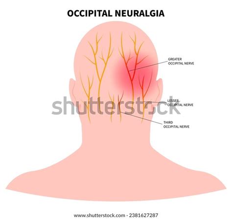 2,814 Occipital Nerve Images, Stock Photos, 3D objects, & Vectors ...