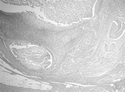 Figure 1 From A Pure Primary Squamous Cell Breast Carcinoma Presenting