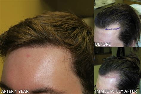 Before and After Picutres | ARTAS - Robotic Hair Transplant