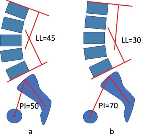 Scielo Brasil Sagittal Alignment Concepts And Spinopelvic Parameters Sagittal Alignment