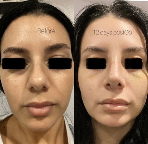 Rhinoplasty Journey So Far 12 Days PostOP R PlasticSurgery