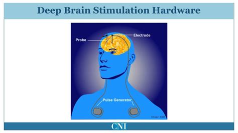 Surgical Treatment For Parkinsons Disease Youtube