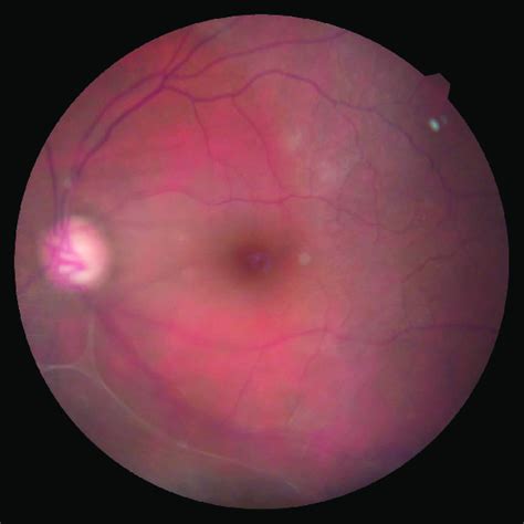 Fundus photo showed subtotal cupping of the optic disc due to glaucoma ...